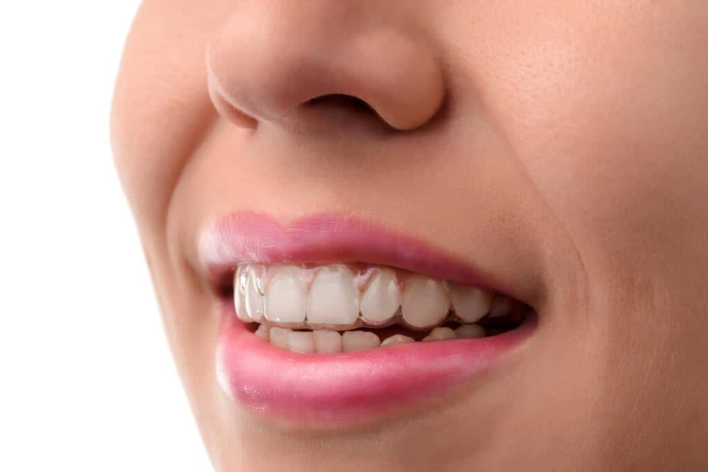 Sequential Aligners Invisalign®, Sure Smile® Angelalign® | Dentists Mandurah and Winthrop